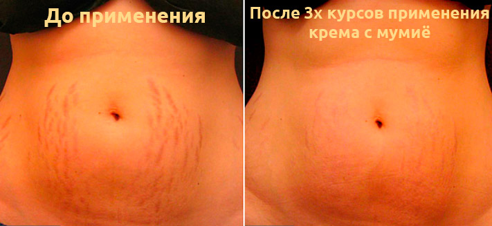 Фото до и после применения мумиё от растяжек